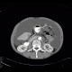 Mixed tumour of appendix, carcinoid and adenocarcinoma, carcinomatous peritonitis: CT - Computed tomography